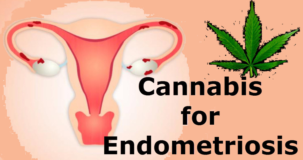 How To Take CBD For&nbsp;Endometriosis